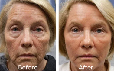 Peptide Botox Alternative Wrinkle Cream